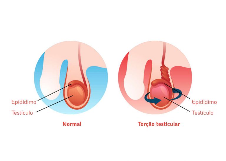 Tor O Testicular E Infertilidade Dr Augusto Bussab Reprodu O Humana