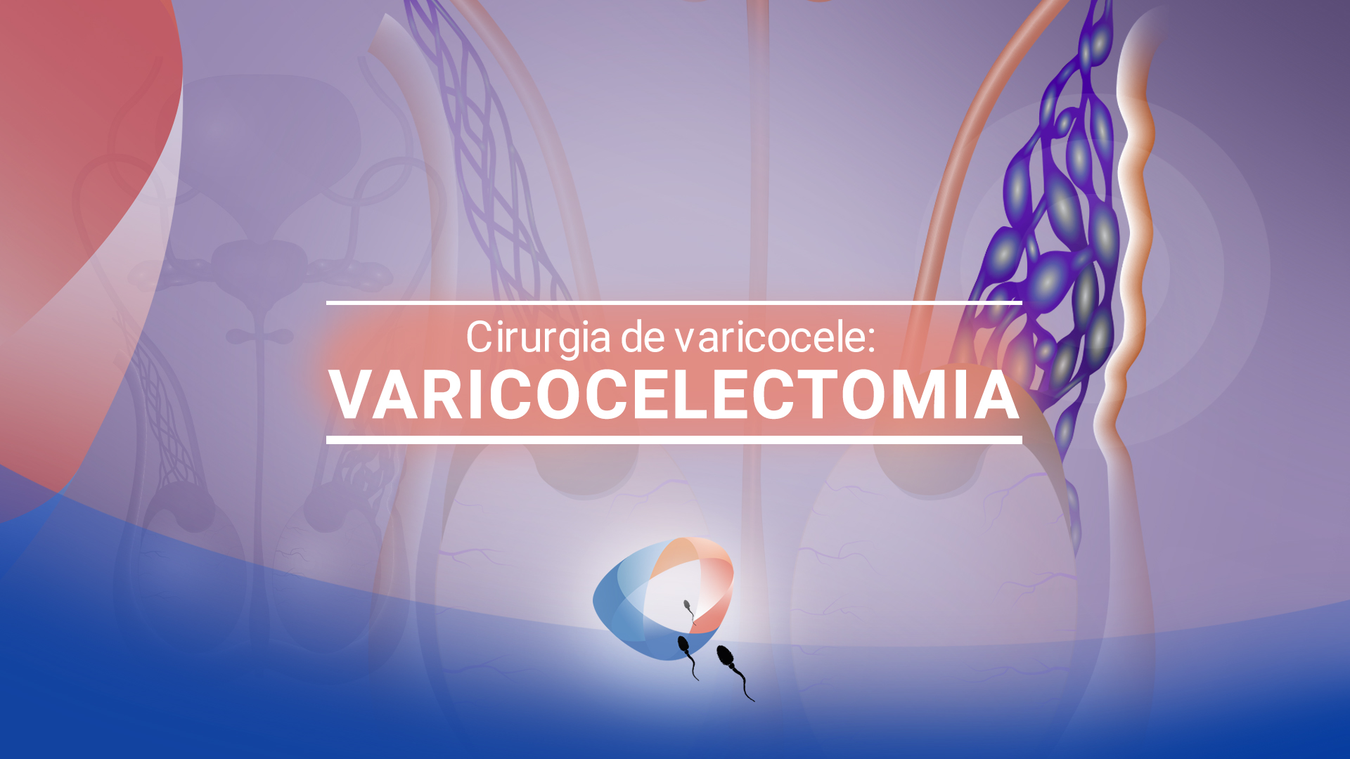 Cirurgia de varicocele: varicocelectomia