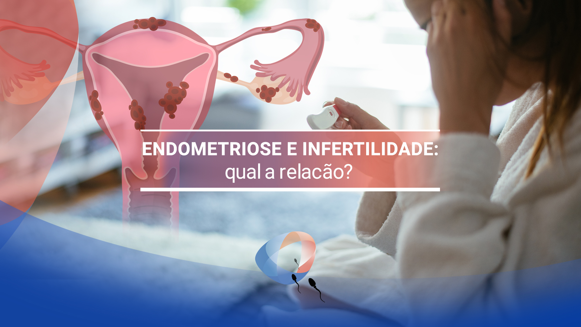 Endometriose e infertilidade: qual a relação?