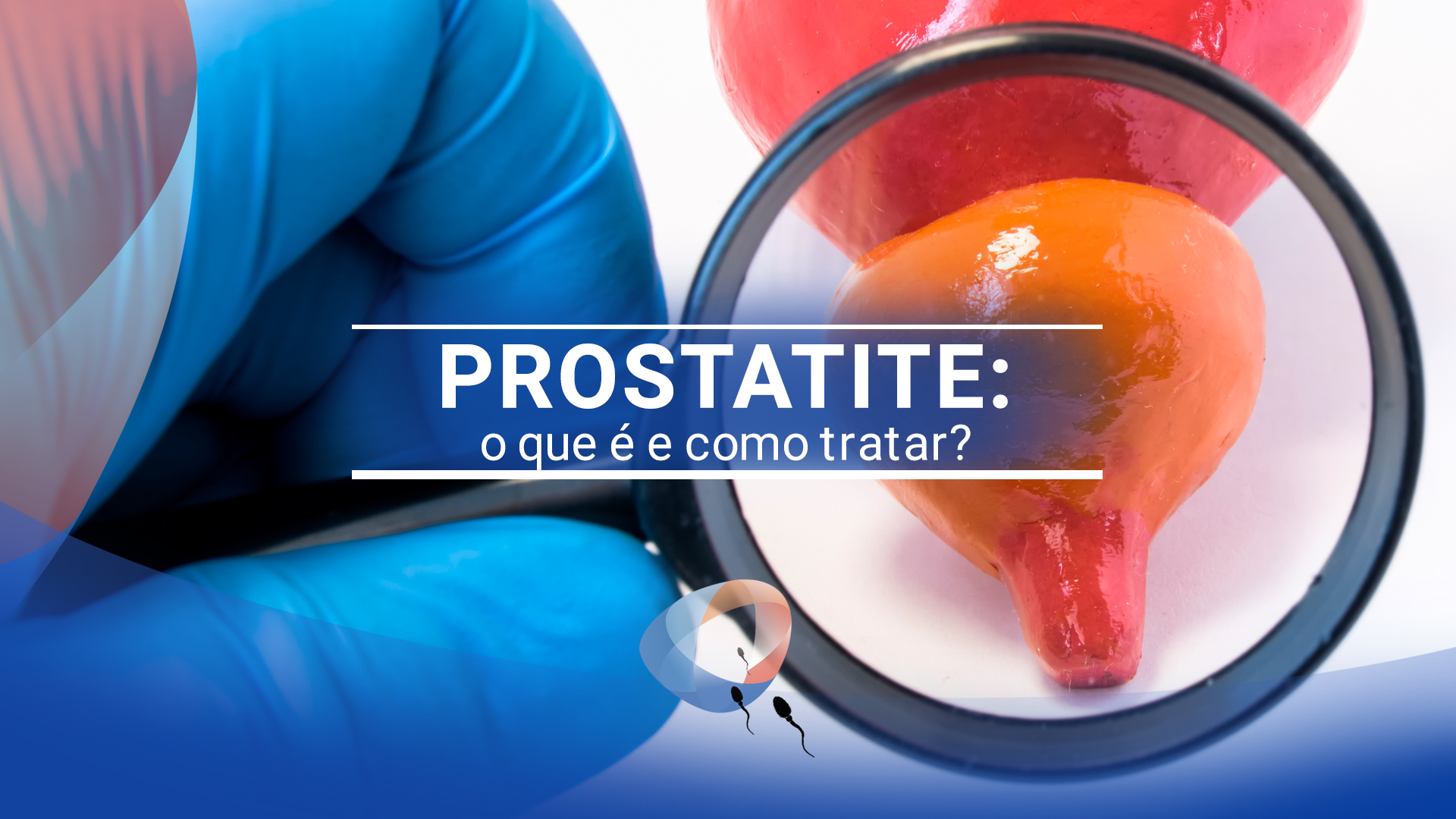 Prostatite: o que é e como tratar?