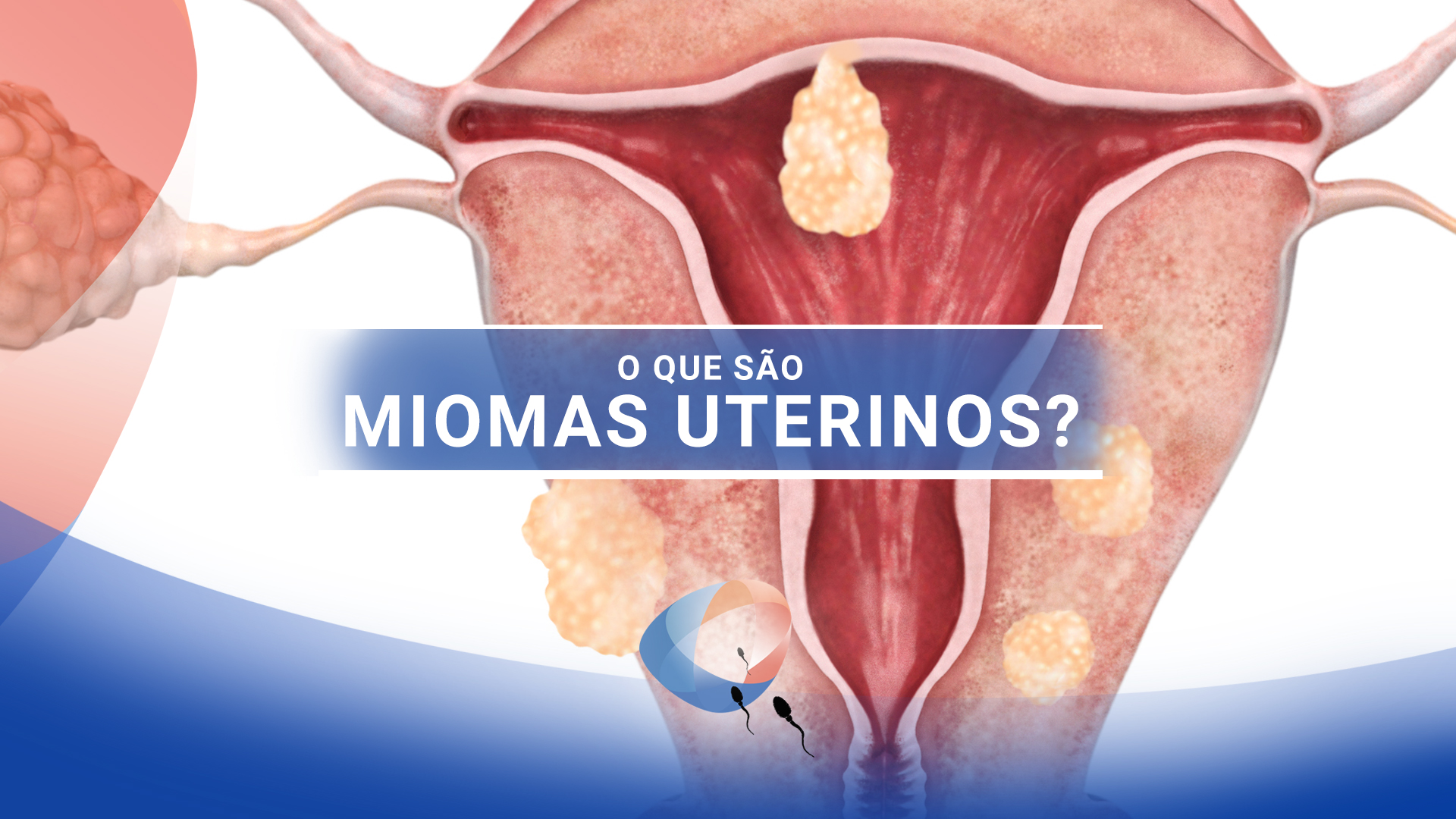 O que são miomas uterinos?