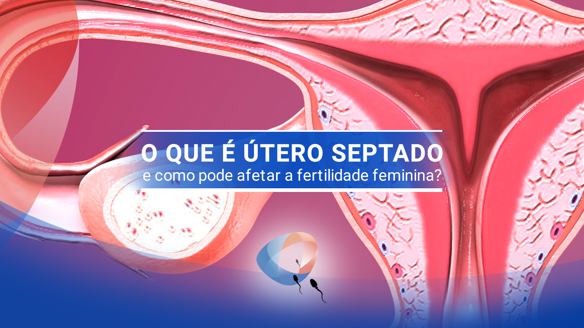 O que é útero septado e como pode afetar a fertilidade feminina?