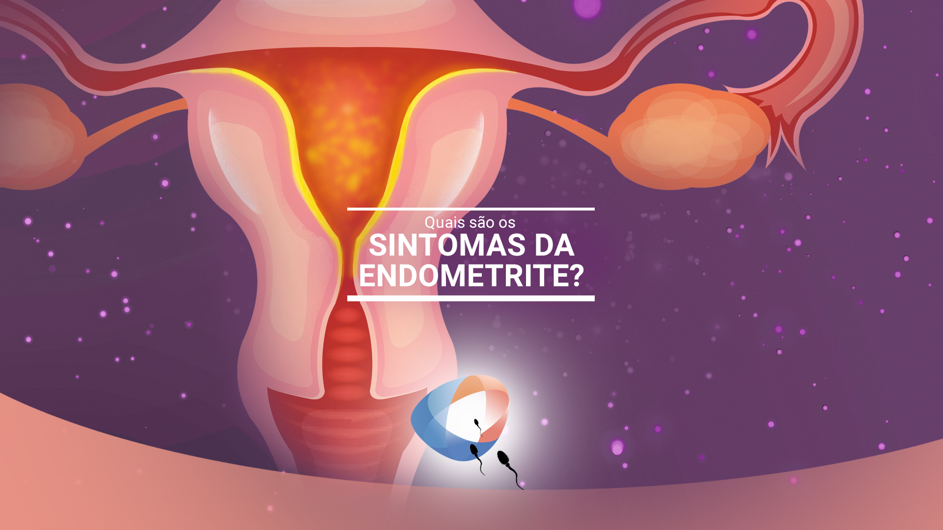 Quais S O Os Sintomas Da Endometrite Dr Augusto Bussab Reprodu O Humana