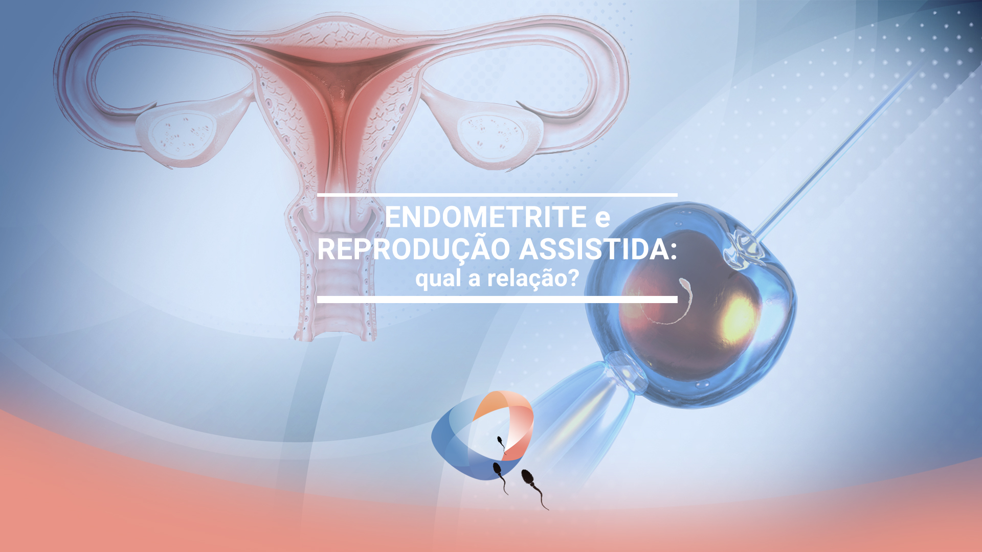 Endometrite e reprodução assistida: qual a relação?