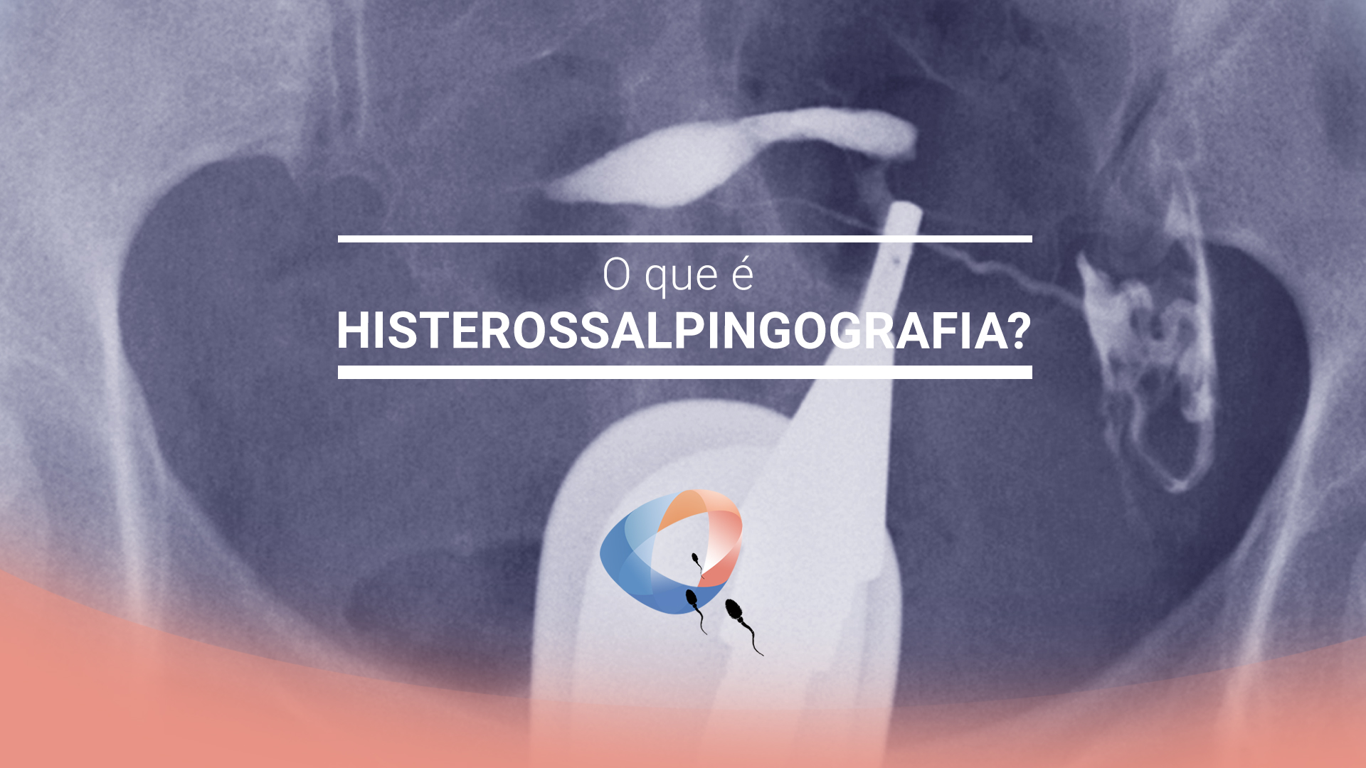 O que é histerossalpingografia?