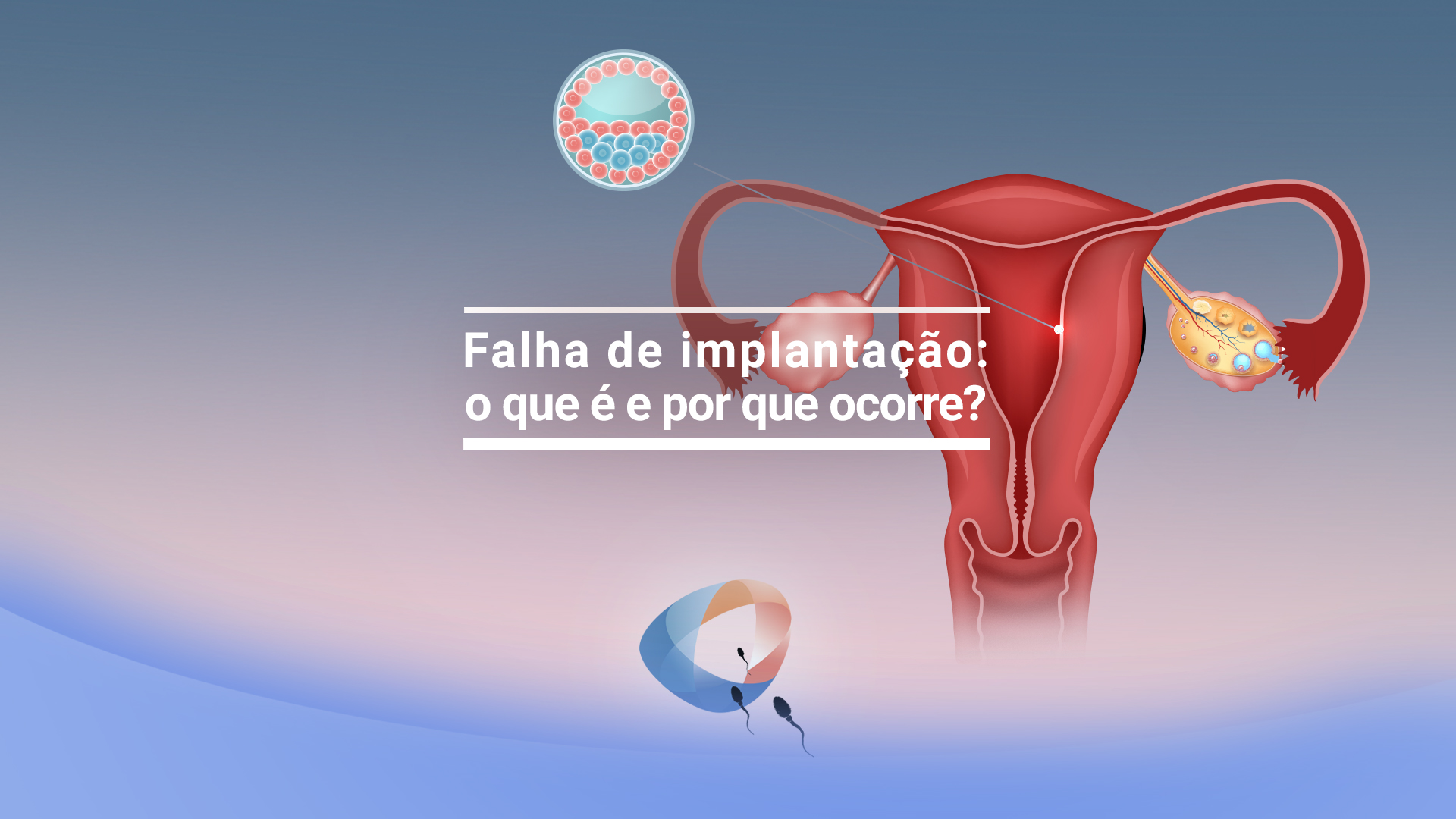 Endometrite e falha de implantação: existe relação?