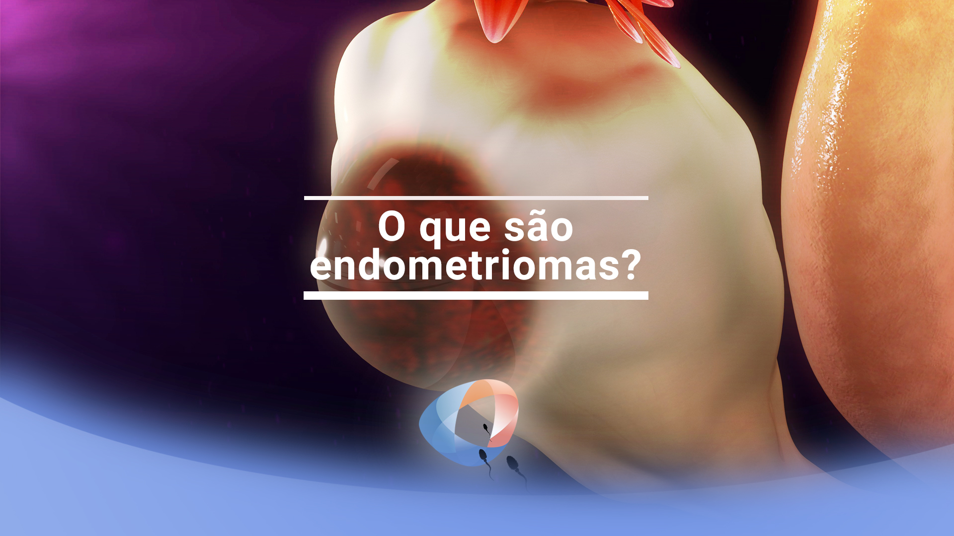 O que são endometriomas?