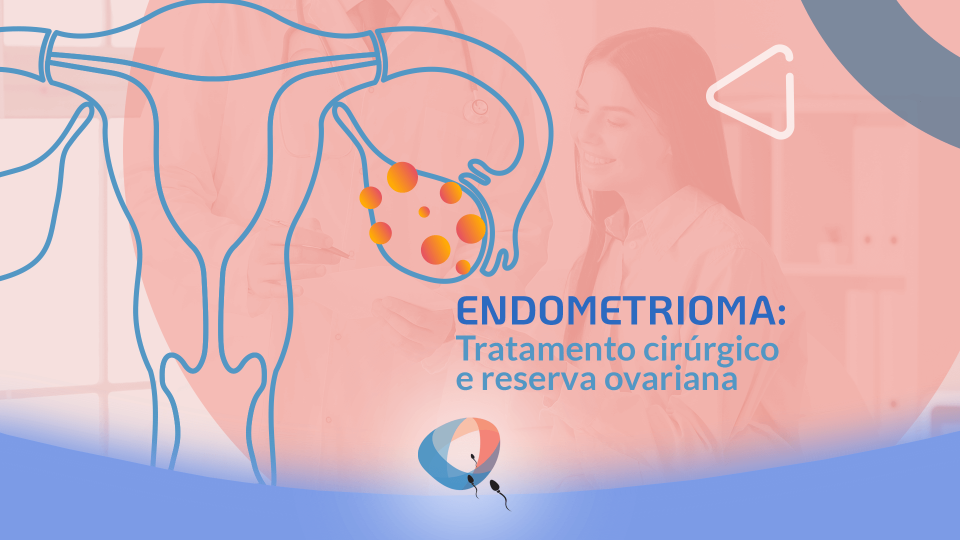 Endometrioma: tratamento cirúrgico e reserva ovariana