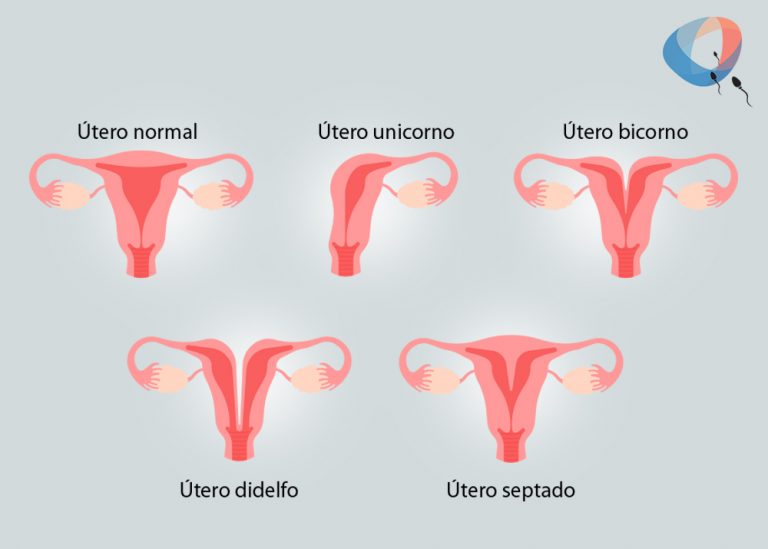 Malforma Es Uterinas O Que S O Dr Augusto Bussab Reprodu O Humana