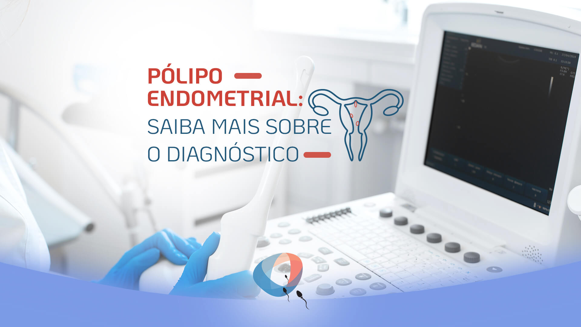 Pólipo Endometrial Saiba Mais Sobre O Diagnóstico Dr Augusto Bussab Reprodução Humana