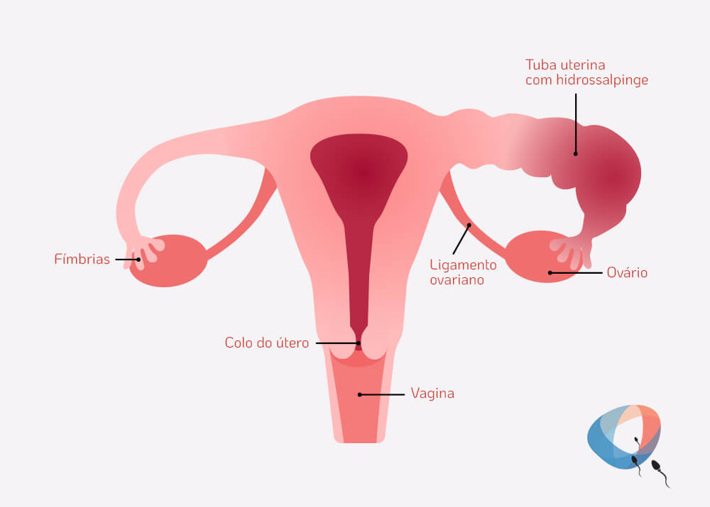 Salpingite: o que é, sintomas, causas e diagnóstico - Tua Saúde