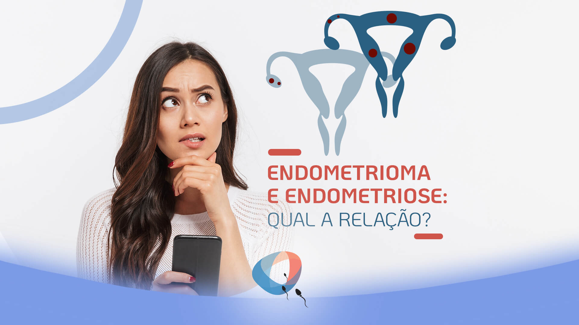 O que é endometrioma?