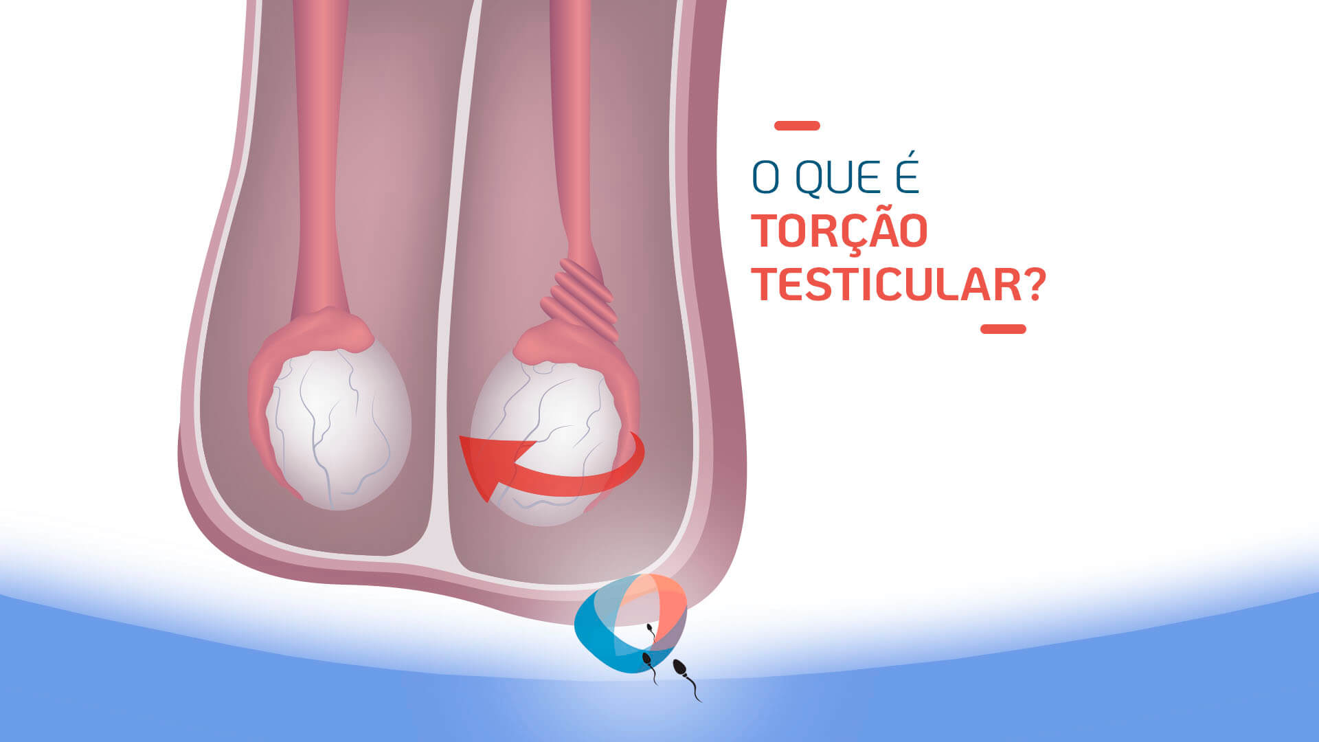 O que é torção testicular?